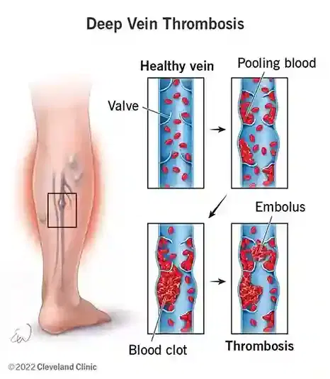 Deep Vein Thrombosis (DVT) Treatment / Thrombolysis Deep Vein Thrombosis (DVT) Treatment / Thrombolysis