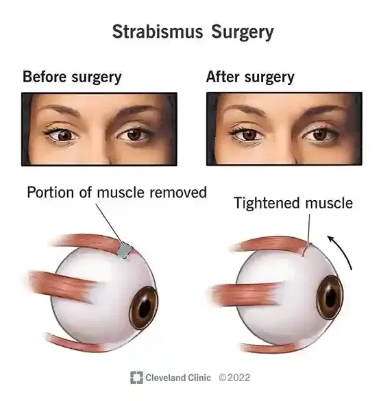 Squint / Strabismus Surgery (Adult) Squint / Strabismus Surgery (Adult)