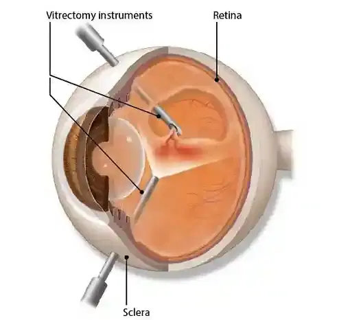 Vitrectomy Vitrectomy