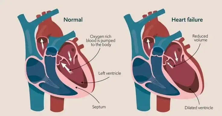 Heart Failure Program (Advanced HF Management) Heart Failure Program (Advanced HF Management)