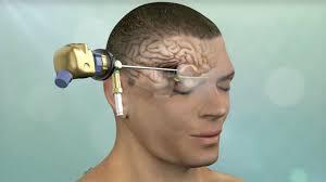 Minimally Invasive Brain Tumor Surgery