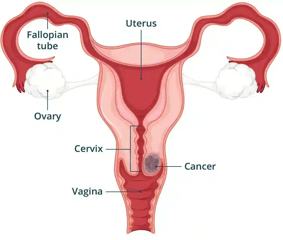 cervical cancer surgery cervical cancer surgery