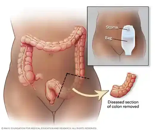 colon cancer surgery colon cancer surgery