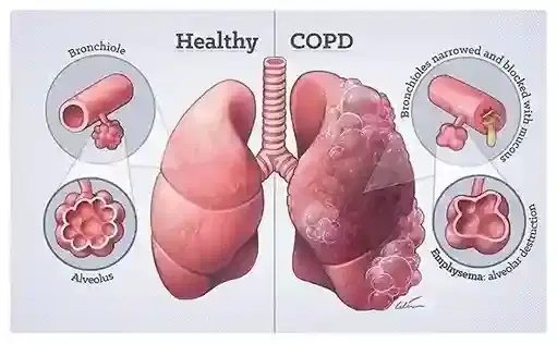 COPD Management Program COPD Management Program