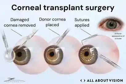 Corneal Transplant (Keratoplasty) Corneal Transplant (Keratoplasty)
