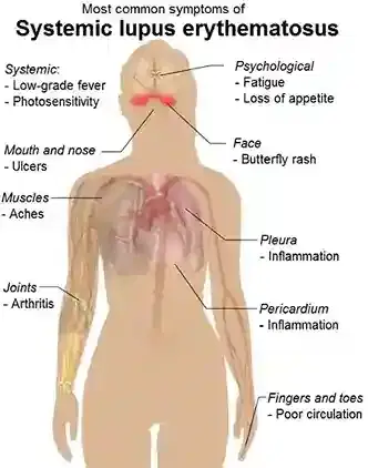 SLE / Lupus Management SLE / Lupus Management