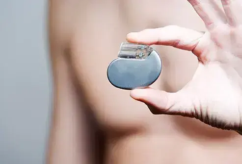 ICD (Implantable Cardioverter Defibrillator) Implantation ICD (Implantable Cardioverter Defibrillator) Implantation