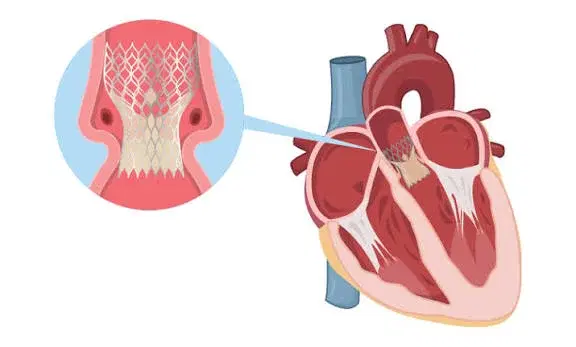 TAVR (Transcatheter Aortic Valve Replacement) TAVR (Transcatheter Aortic Valve Replacement)