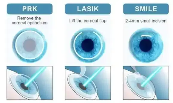 LASIK / SMILE / PRK (Refractive Surgery) LASIK / SMILE / PRK (Refractive Surgery)
