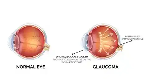 Glaucoma Surgery (Trabeculectomy / MIGS) Glaucoma Surgery (Trabeculectomy / MIGS)