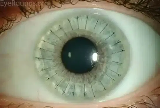 Cataract Surgery (Phaco with IOL) Cataract Surgery (Phaco with IOL)