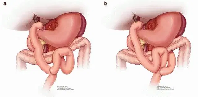 palliative cancer surgery palliative cancer surgery