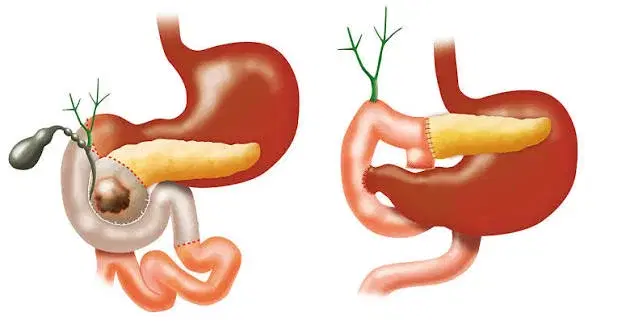 Pancreatic Cancer Surgery (Whipple) Pancreatic Cancer Surgery (Whipple)