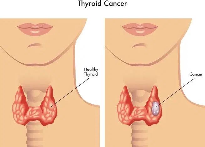 thyroid cancer surgery thyroid cancer surgery