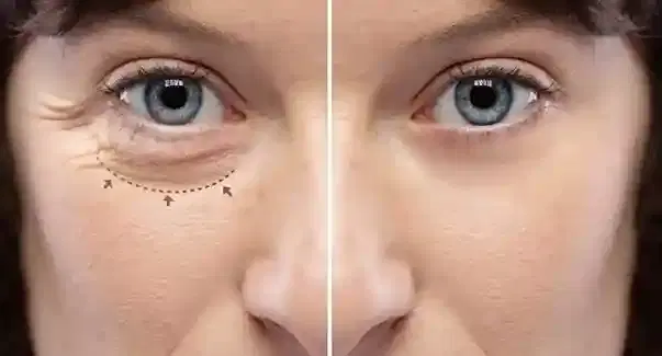 oculoplastic surgery oculoplastic surgery