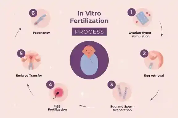 IVF (In Vitro Fertilization) Cycle IVF (In Vitro Fertilization) Cycle