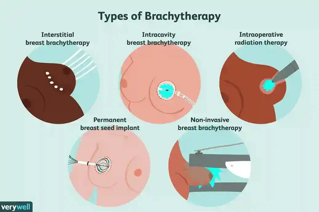 brachytherapy brachytherapy
