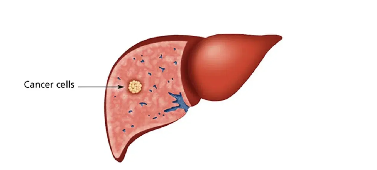 liver cancer surgery liver cancer surgery
