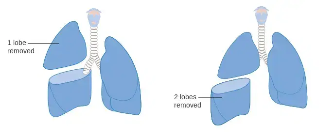 lung cancer surgery lung cancer surgery