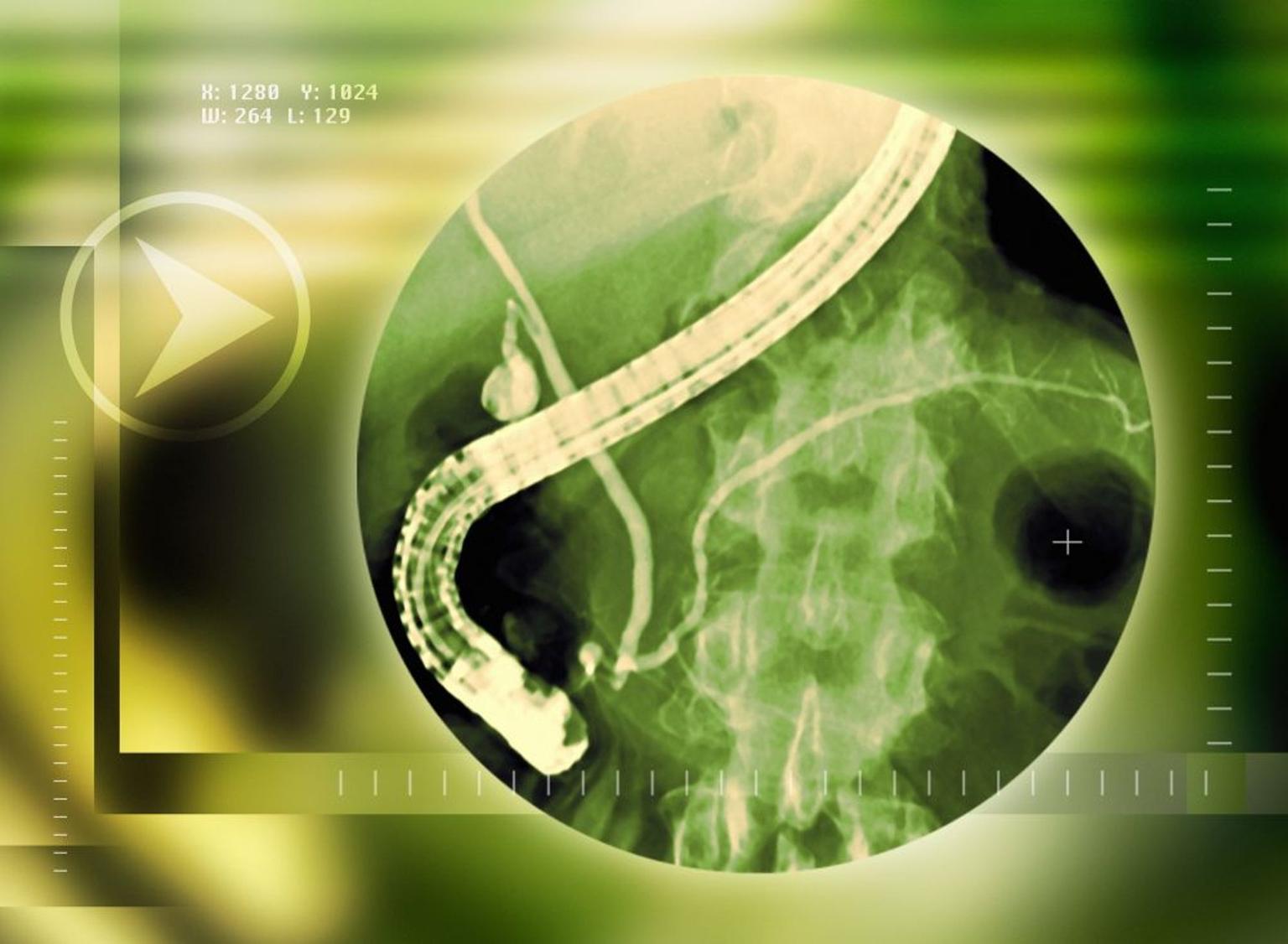 ERCP (Endoscopic Retrograde Cholangiopancreatography)