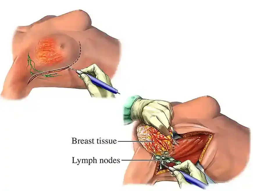 mastectomy surgery mastectomy surgery