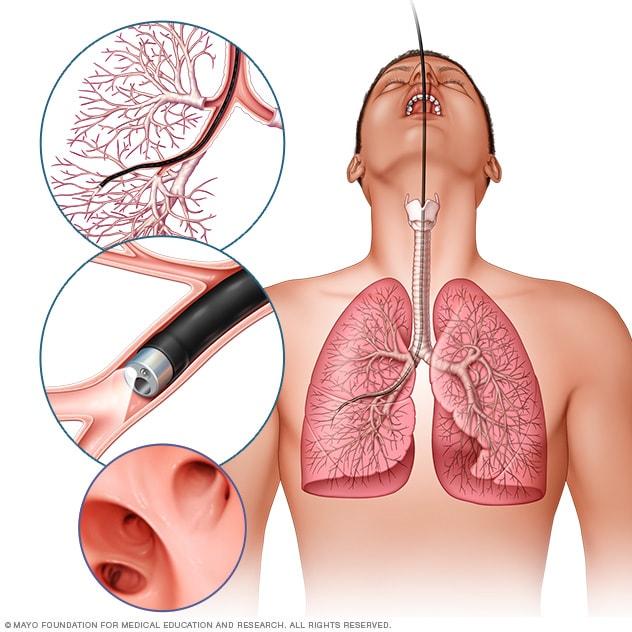 Lung Transplant
