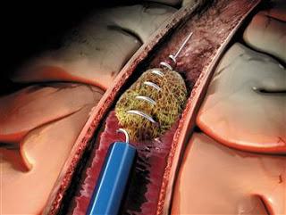 Endovascular Thrombectomy for Stroke