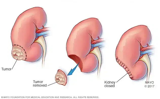 kidney cancer surgery kidney cancer surgery