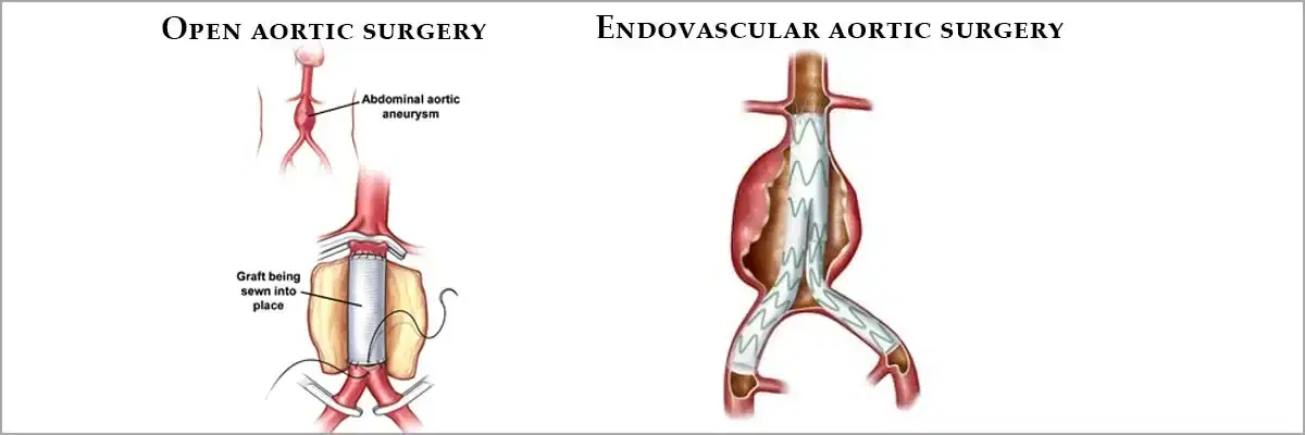 Aortic Aneurysm Repair (Open/Endovascular) Aortic Aneurysm Repair (Open/Endovascular)