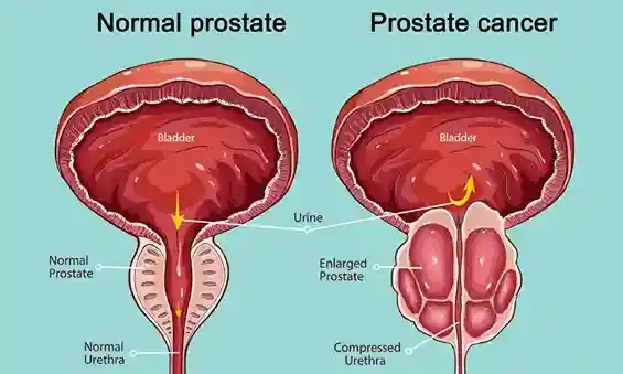 prostate cancer surgery prostate cancer surgery