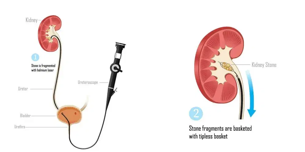 Laser Treatment for Kidney Stones (RIRS)