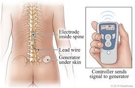 Spinal Cord Stimulation