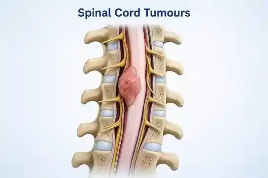 Spinal Cord Tumor Surgery Spinal Cord Tumor Surgery