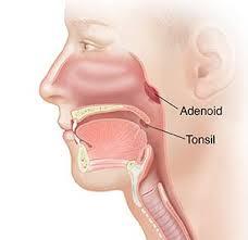 Tonsillectomy & Adenoidectomy