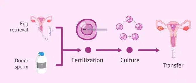 Donor Sperm IUI/IVF Donor Sperm IUI/IVF