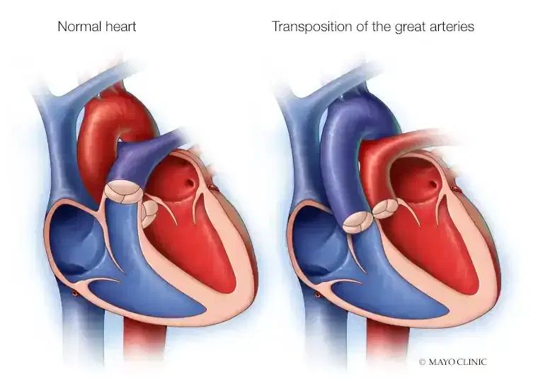 congenital heart surgery congenital heart surgery